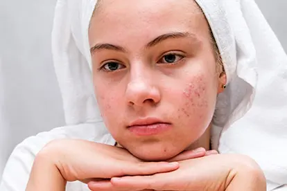 Acne – Causes, Symptoms, Cream – Zeolite Knowledge Acne - Causes, Symptoms, Cream - Zeolite Knowledge