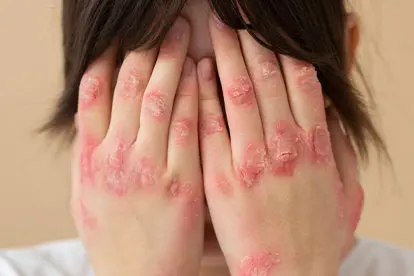 Psoriasis - Autoimmune-Disease - Zeolite Knowledge