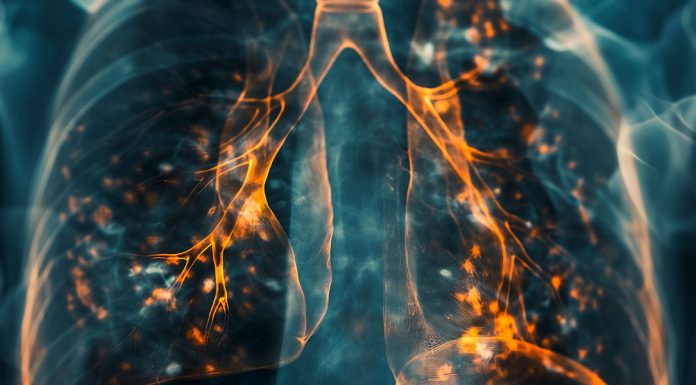 COPD-Krankheit - Umweltgifte - Mikroplastik
